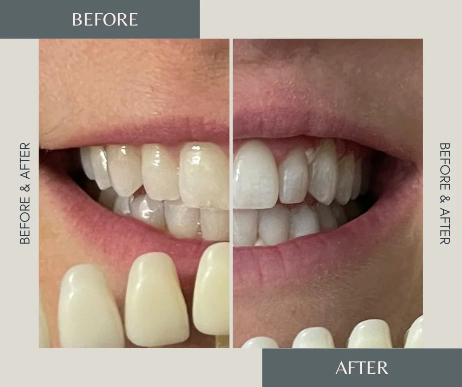Before and after teeth whitening treatment.