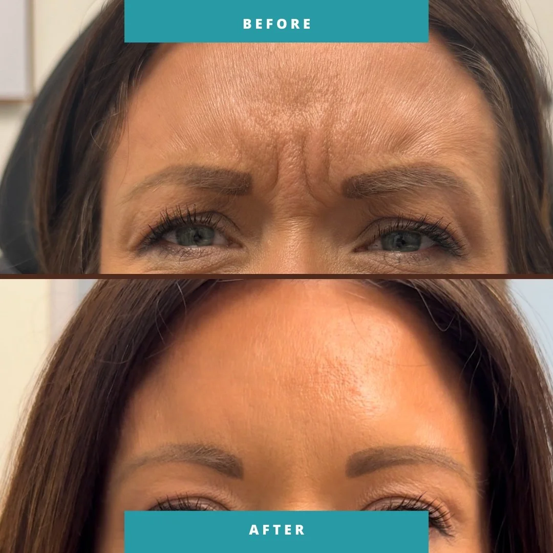 Before and After tox treatment