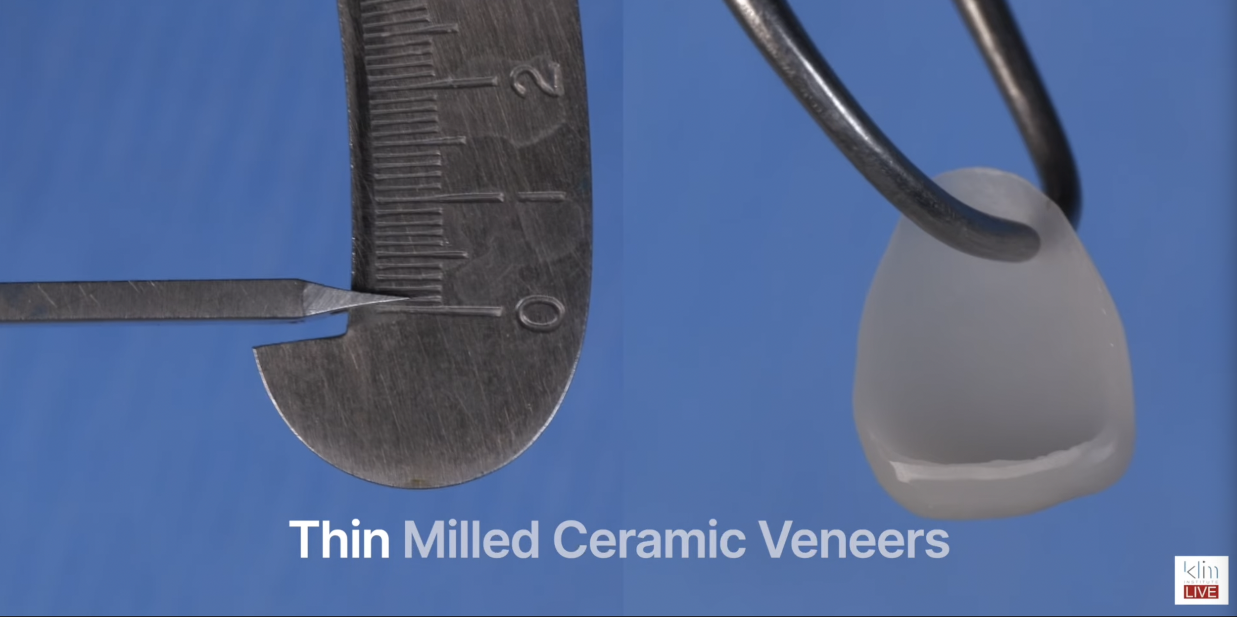 Prepless Veneers With CAD/CAM: A Overview to Ultra-Thin, High-Aesthetic Ceramic Veneers
