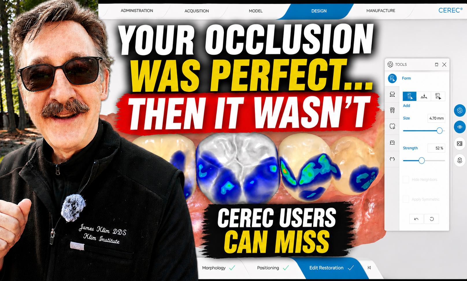 Why CEREC Restorations Suddenly Start Milling High (And How to Fix It)