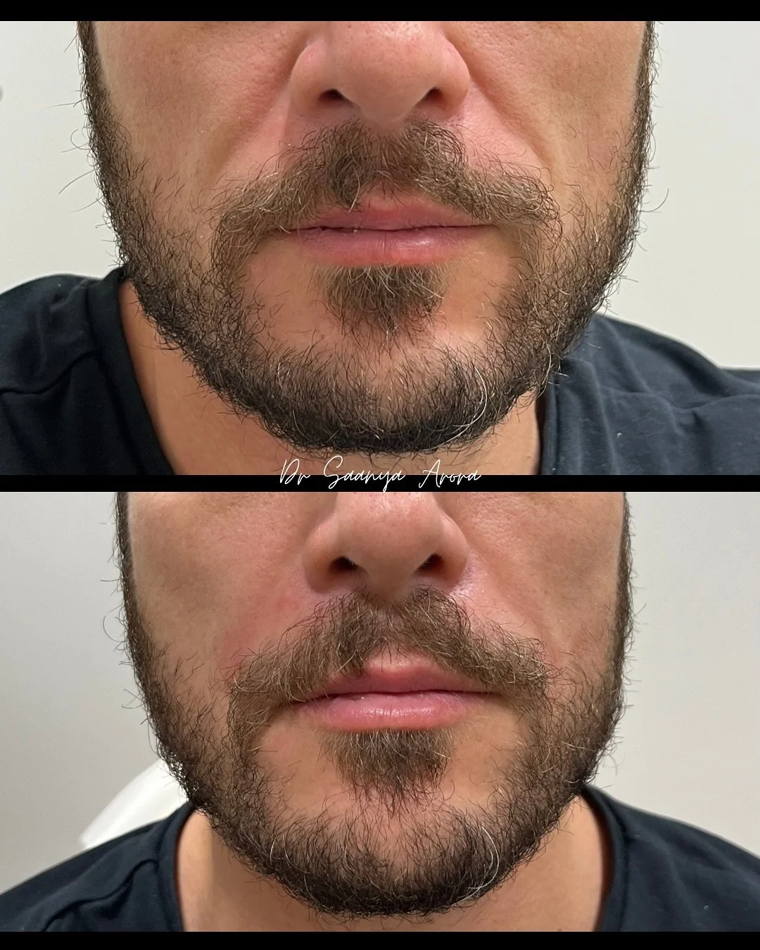 Let&rsquo;s talk Nasolabial folds (Nose to mouth lines). 

These often get more prominent with age, due to loss of volume in the cheeks, sometimes these lines can also be genetic. 

With just a minimal amount of dermal filler, we can naturally lift t