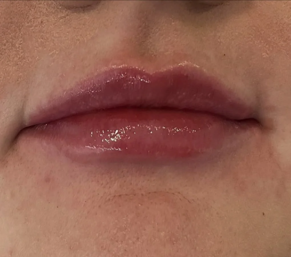 Lips 1ml top up ✨some swelling and redness present xx

We rebalanced the ratio between the top and bottom lip and added some subtle volume overall 

Natural and beautiful 😍 

#lipfillerinjections #lipfillerbeforeandafter #lipfillers #cotswoldlipfill