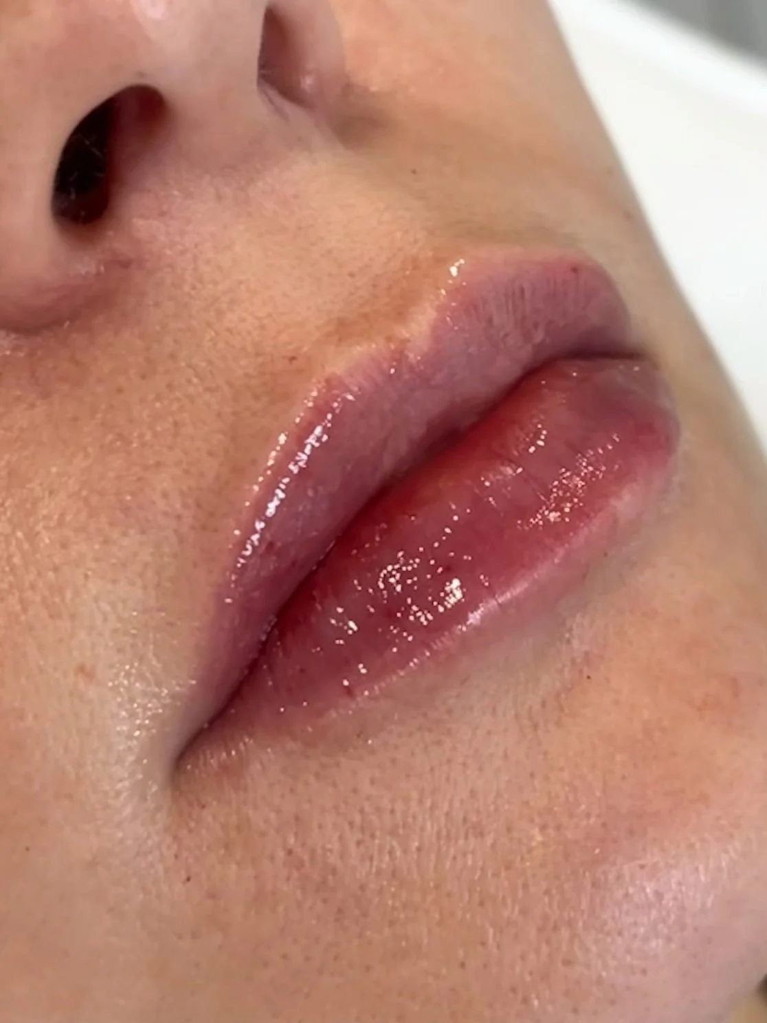 Swipe for before 👉
During winter months, a little bit of filler goes a long way, boosting hydration and adding subtle volume ✨

DM to book 

#lipfillerbeforeandafter #lipfillercheltenham #cheltenhamaestheticspractitioner #doctoraesthetics #aesthetic