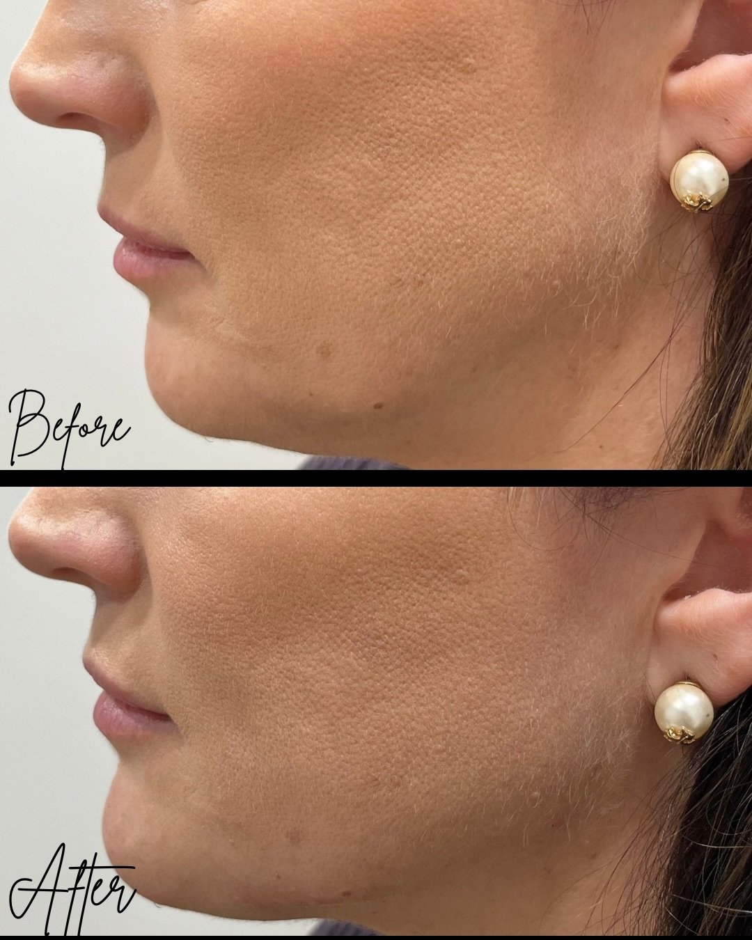 Natural-looking structure that enhances your profile from every angle ✨
Performed safely by GMC registered aesthetic doctor, Saanya in Cheltenham.

We used only 2ml to give this beautiful, subtle result, concealing any jowling, resulting in a defined