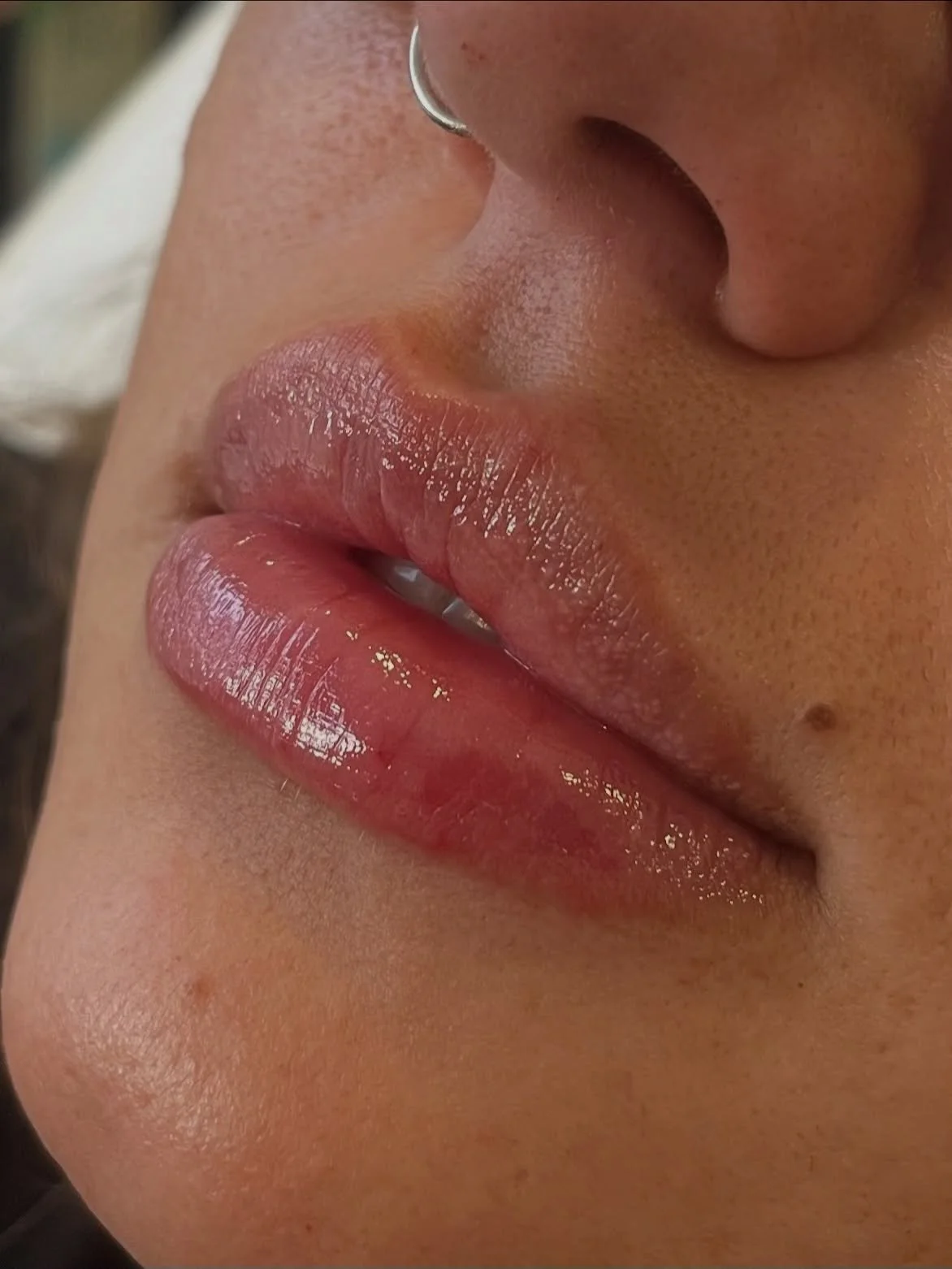 Lip filler diaries ✨

Another lovely little natural lip filler, focusing on hydration and balance, rather than any added volume in this case 

All treatments performed by Aesthetic Doctor Saanya 

DM to book 

#lipfillerbeforeandafter #lipfillerchelt