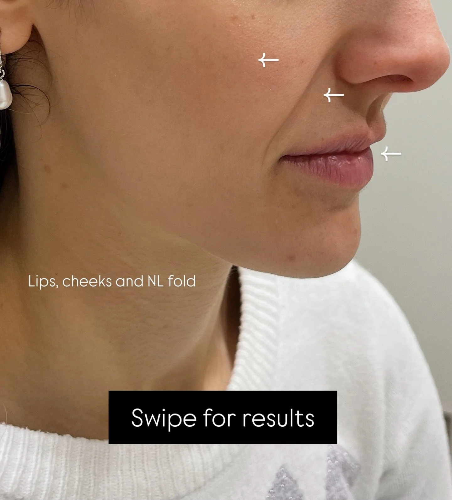 Combination filler treatments are great to enhance and lift targeted areas and achieve natural facial balance. 

A total of 2ml only was used to achieve this result. Swelling is present as this was just after treatment. Fillers take 2-4 weeks to full