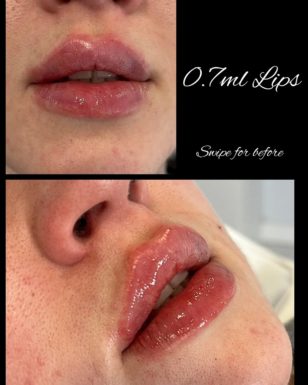 0.7ml. Subtle. Balanced. ✨ we focussed on enhancing the cupids bow, lip balancing and adding subtle volume overall.

A natural lip enhancement is designed to restore hydration, refine shape, and enhance what was already there &mdash; not change it.
S