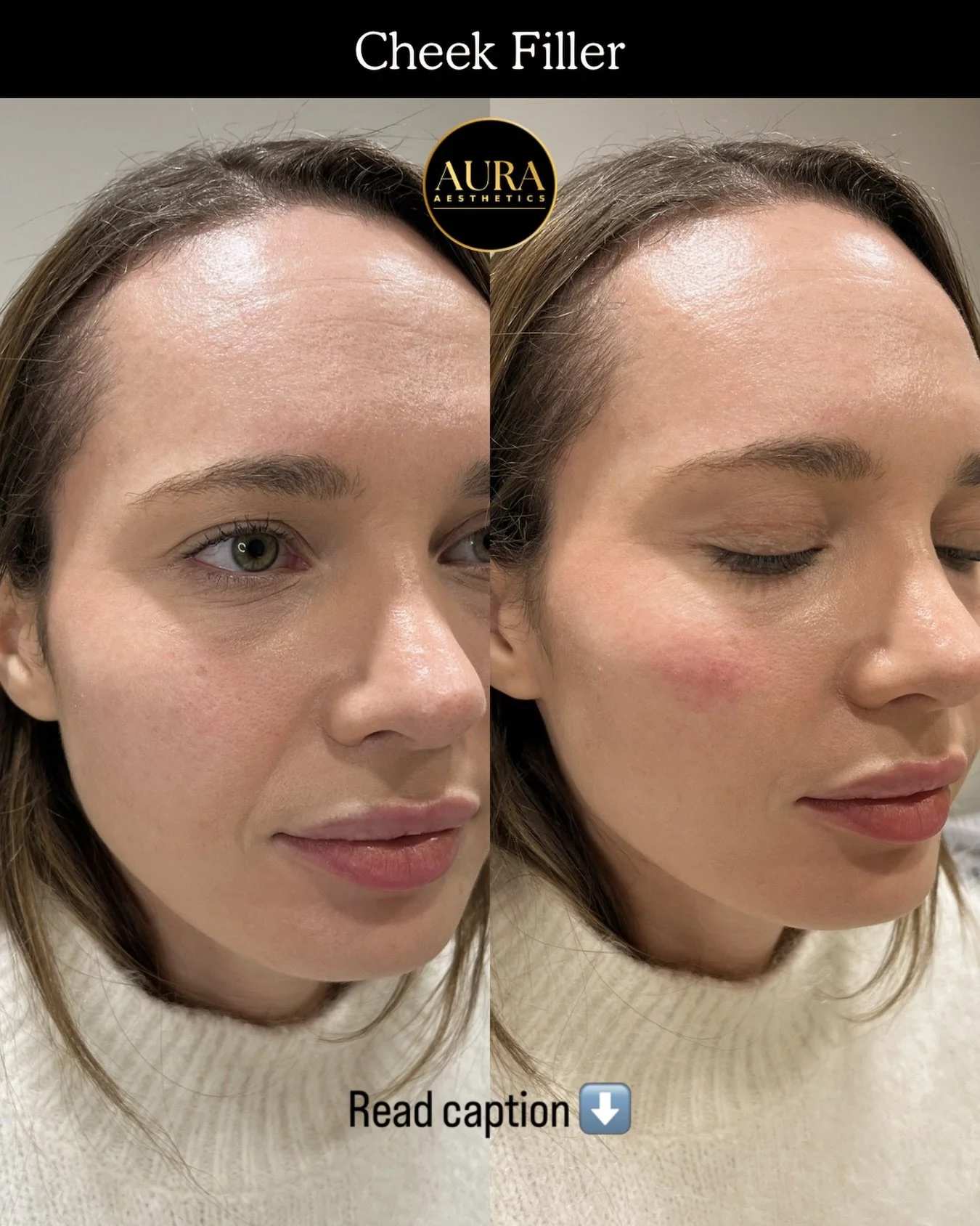 Cheek filler is a great way to lift and rejuvenate the mid face. It changes the way light bounces off the face - observe the shadow around the eye in the before photo vs the after photo. 
With strategic placement of filler, we can achieve very natura