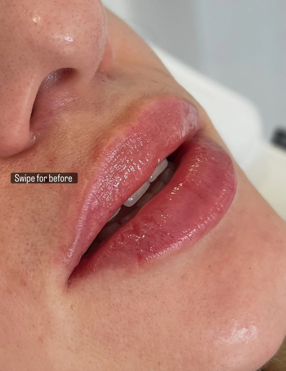 The perfect pout. Subtle but juicy 💋

DM or use booking link in bio 

#cheltenhamwomeninbusiness #lipfillercheltenham #lipfillerbeforeandafter #dermalfillercheltenham #cheltenhamaesthetics