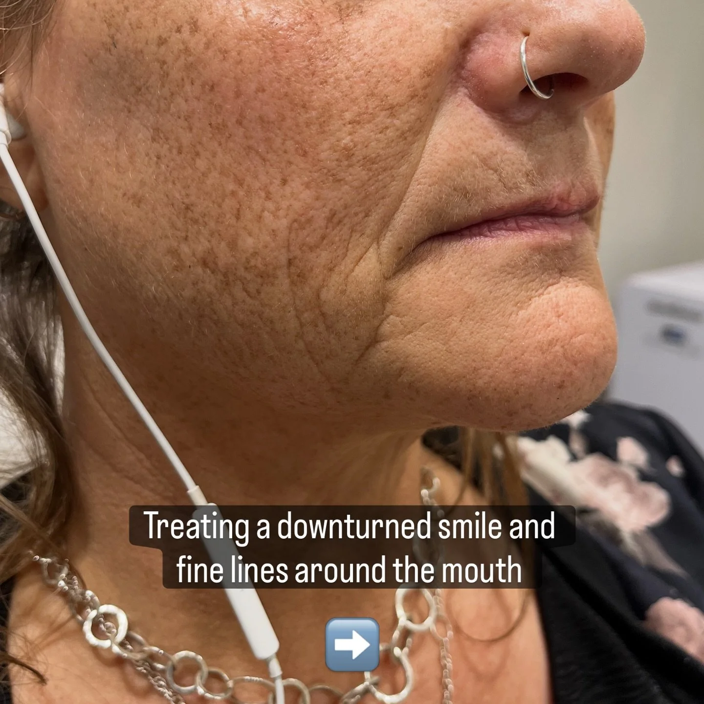 Strategic placement of filler can help smooth and lift fine lines as well as deep folds caused by ageing. 
All treatments are performed by GMC registered Dr Saanya. 

Book your FREE consultation using the link in bio

#dermalfillercheltenham #fillerb