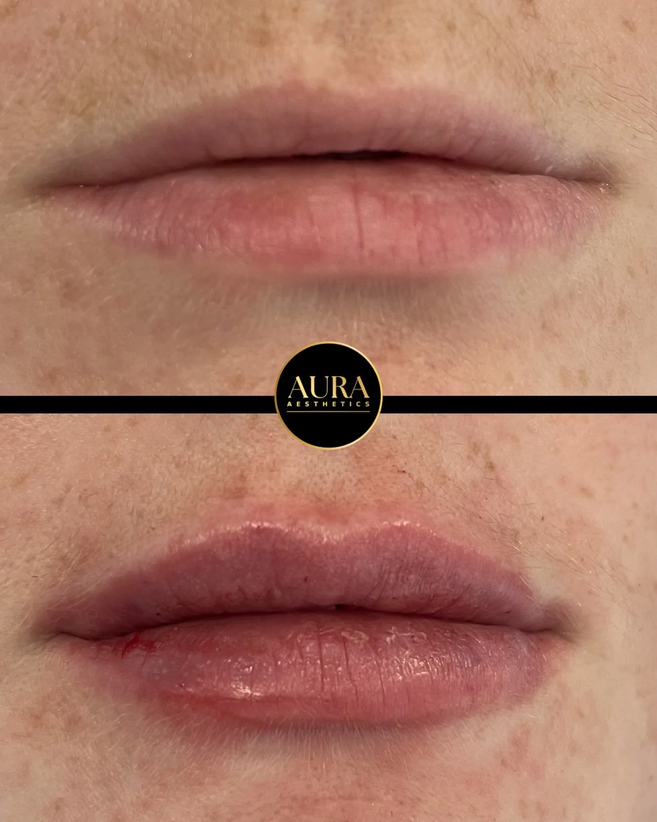 Subtle lip volume created with 0.7ml ✨

All treatments performed by GMC registered Dr Saanya. 

#lipfillercheltenham #naturallipfiller #lipvolumecheltenham #fillerscheltenham #aestheticdoctorcheltenham