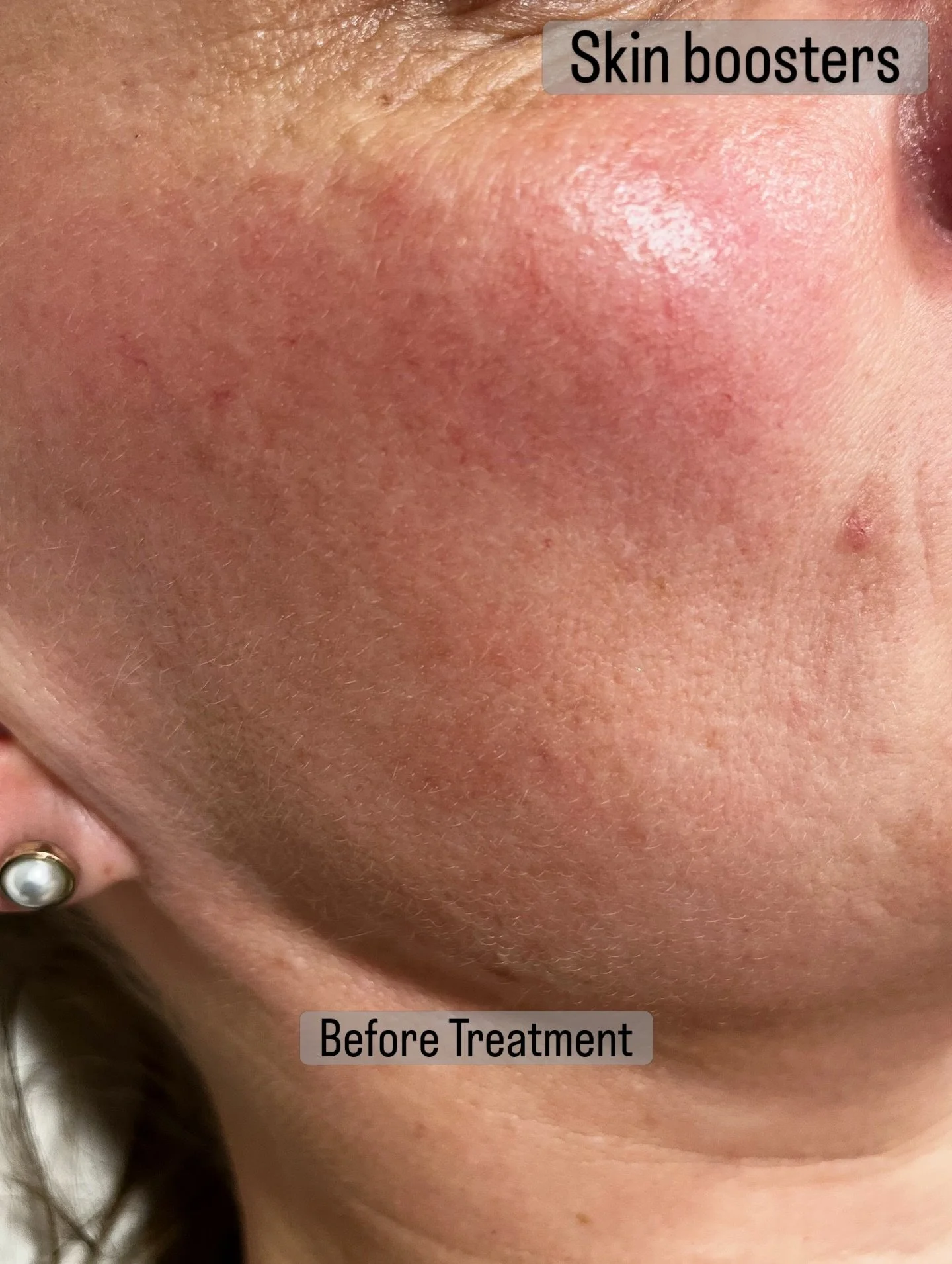 Ever heard of Profhilo? 

This injectable skin rejuvenation treatment helps with skin firmness and elasticity, helping reduce the appearance of fine lines. 
It&rsquo;s a skin booster made of hyaluronic acid. After just 1-2 sessions, skin is softer, s