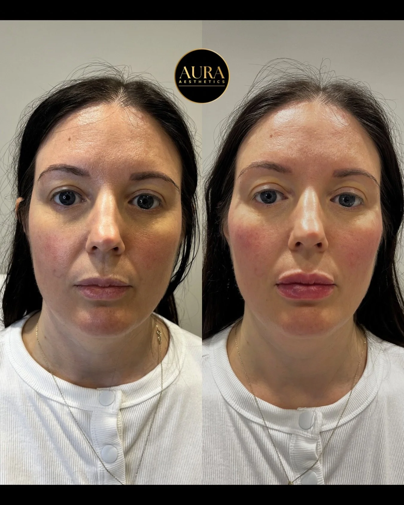 Subtle cheek and lip rejuvenation ✨ 

This was straight after the treatment so some swelling and bruising is expected, especially in the lips. 
The result? A subtle, natural refresh which keeps you looking like you 🫶 

All treatments are performed b