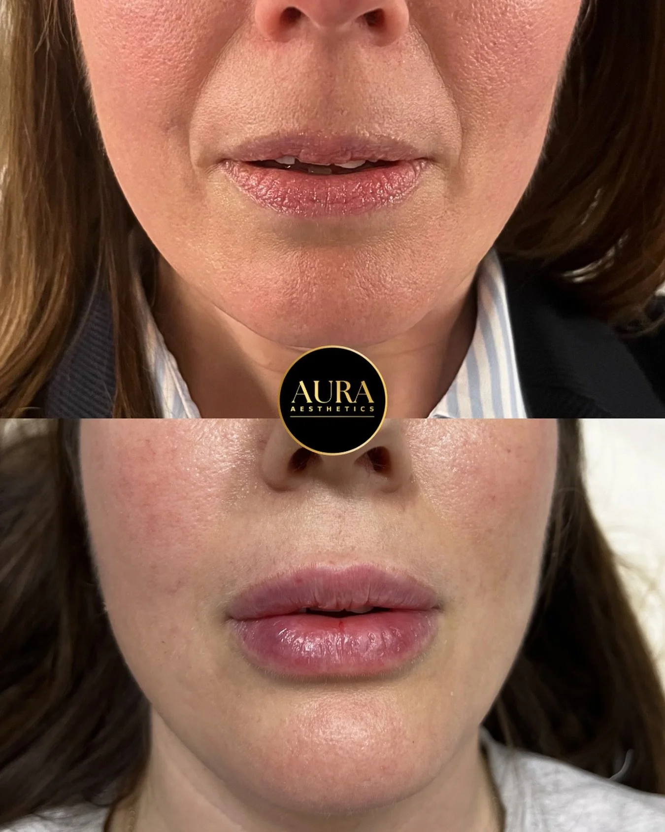 Lil client transformation ✨ 

We focussed on building the lips slowly over time, to give increased volume without the migration. We also slowly built the cheeks to smoothen and lift the nasolabial folds. Overall, we aimed to a refreshed and rejuvenat