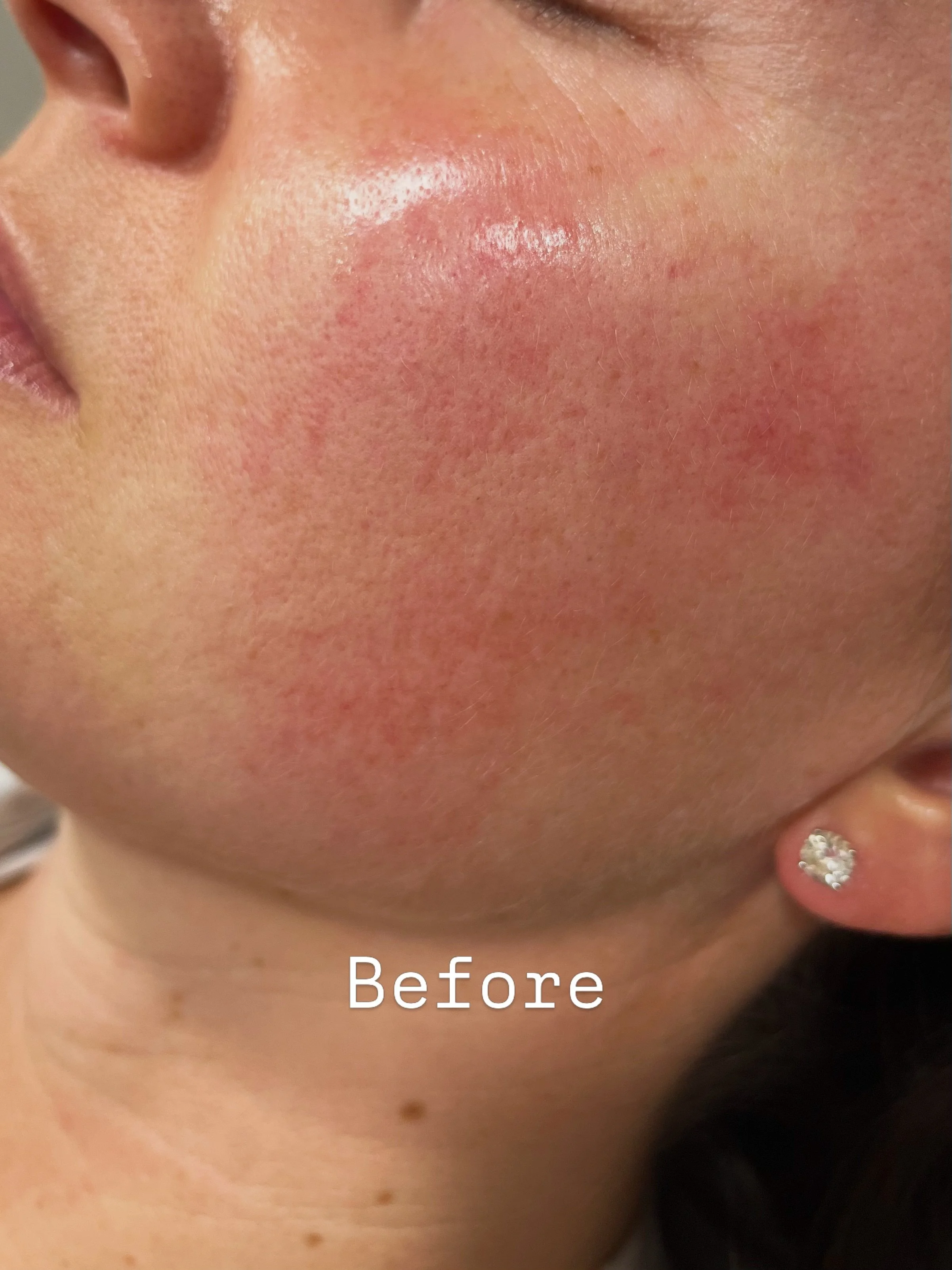 Skin boosters ✨ 

Skin boosters are injectable treatments designed to deeply hydrate, improve skin texture, boost elasticity, and give your skin that healthy, radiant glow ✨ Unlike traditional fillers, skin boosters focus on overall skin quality rath