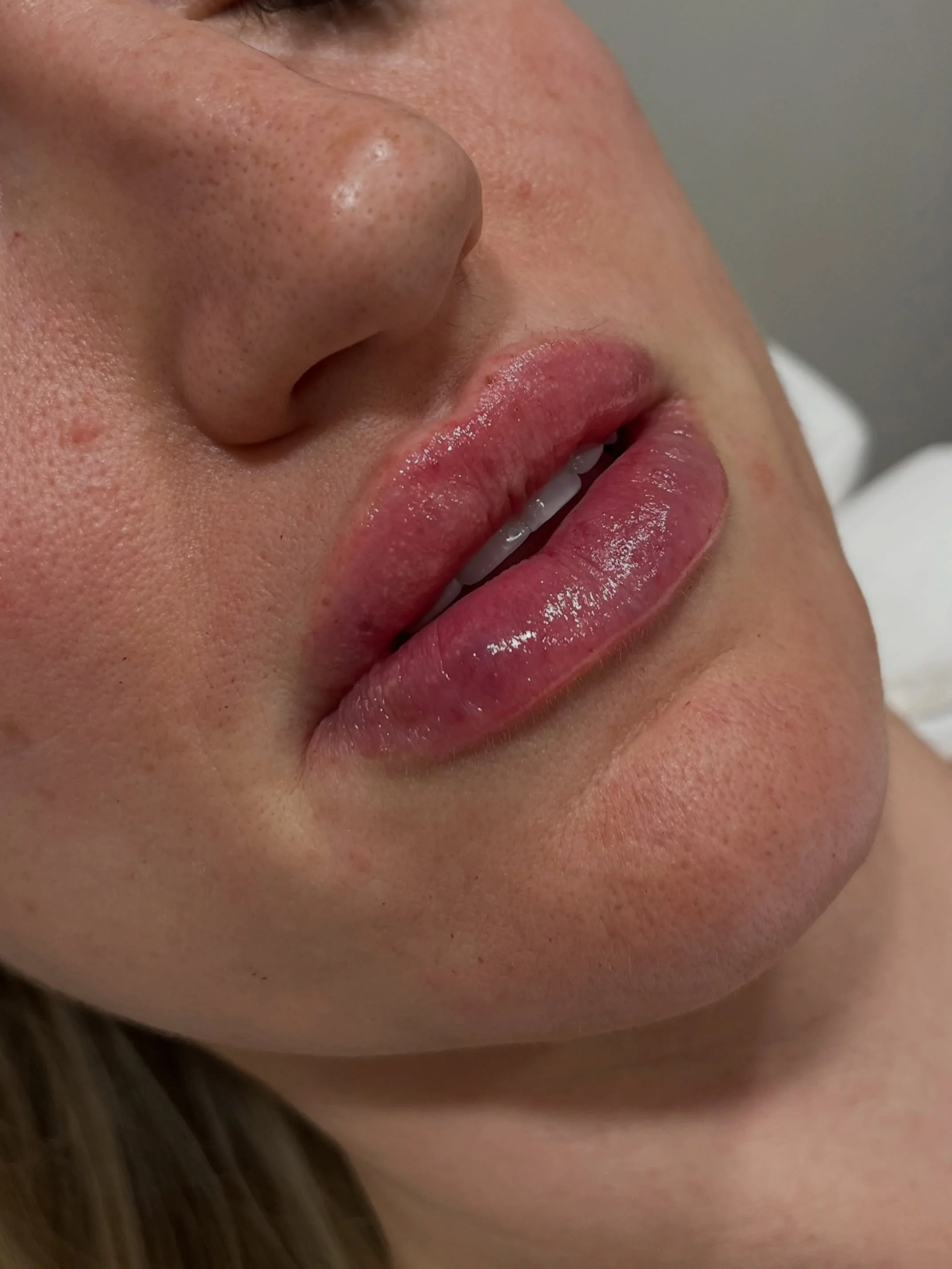 @teoxane_uk RHA kiss lips. Some swelling present. Swipe for before &mdash;>

Lips can be enhanced naturally and subtly. All treatments are performed by Dr Saanya. 

#lipfillercheltenham #dermalfillercheltenham #aestheticsdoctorcheltenham #bishopsc