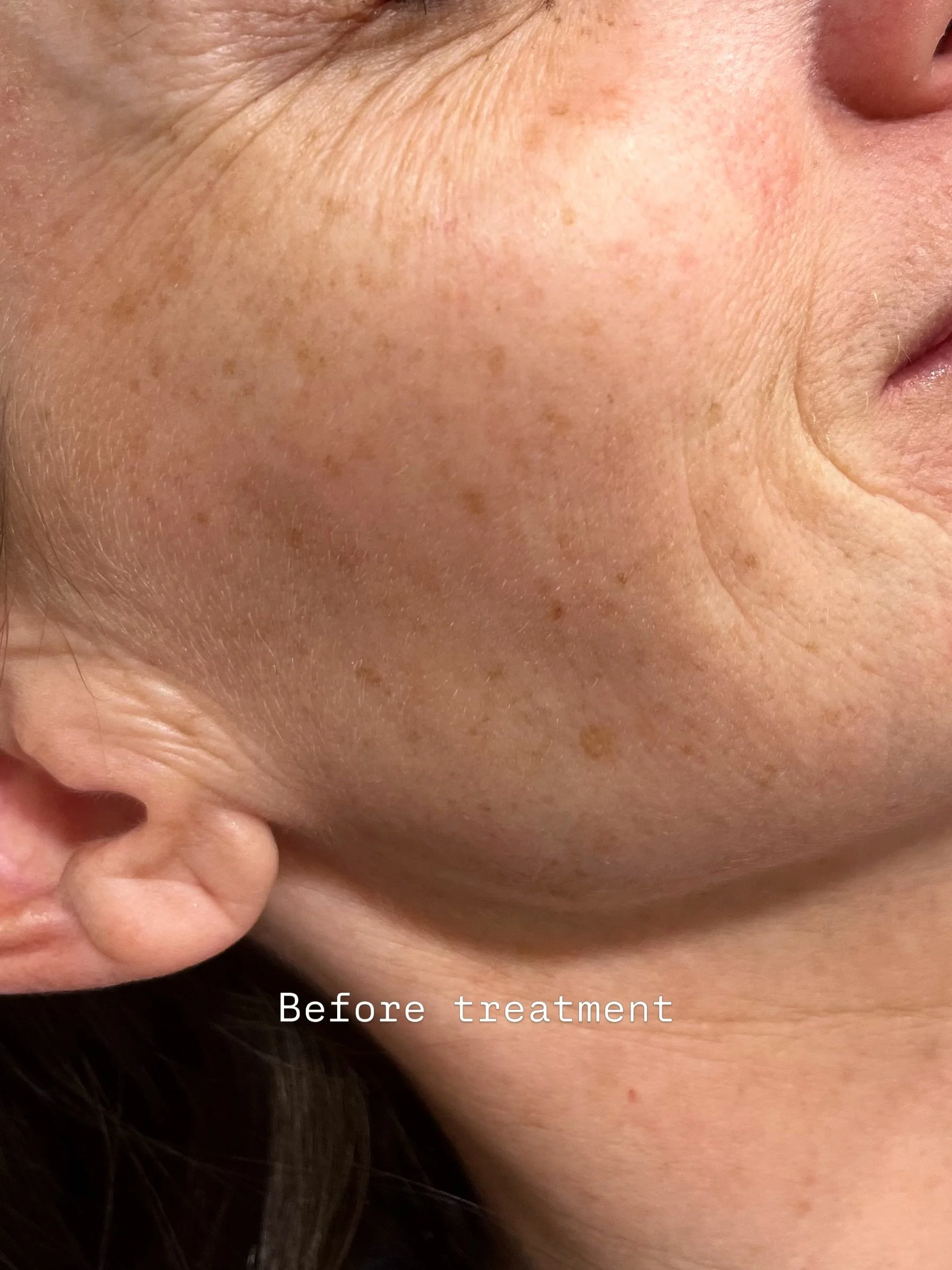 The power of PROFHILO 🤩

The photo before treatment shows some fine lines on the skin surface and a subtle deficit in the lower cheek area. Profhilo works by triggering collagen and elastin production, helping to rejuvenate the skin and give you bac