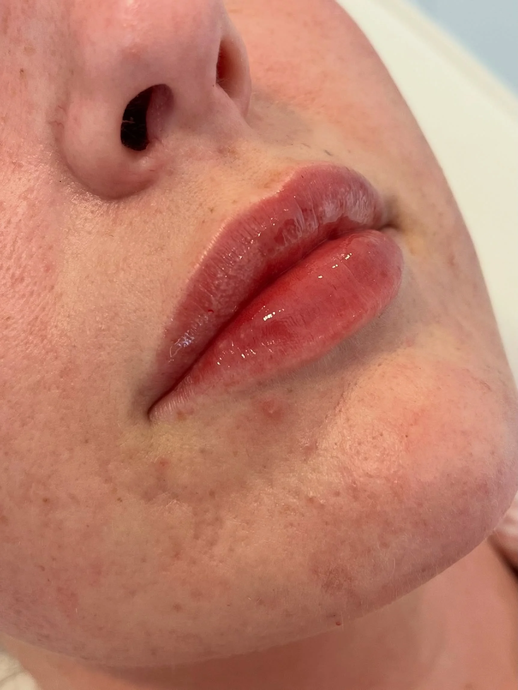 Natural lip filler ✨ swipe for before ➡️

This lovely client came in having had lip filler previously, which she felt looked extremely overfilled. After dissolving her lips, she waited several years before she decided to have them done again. 
She wa