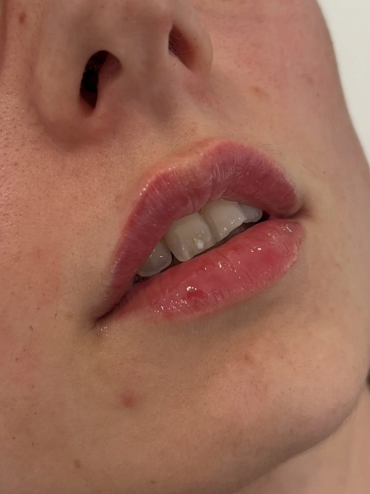 Lip filler transformation. Keeping you looking like you, just enhanced ✨ 

DM to book 

#lipfillerbishopscleeve #lipfillercheltenham #lipfillergloucester #naturalfillerresults #aestheticsdoctorcheltenham