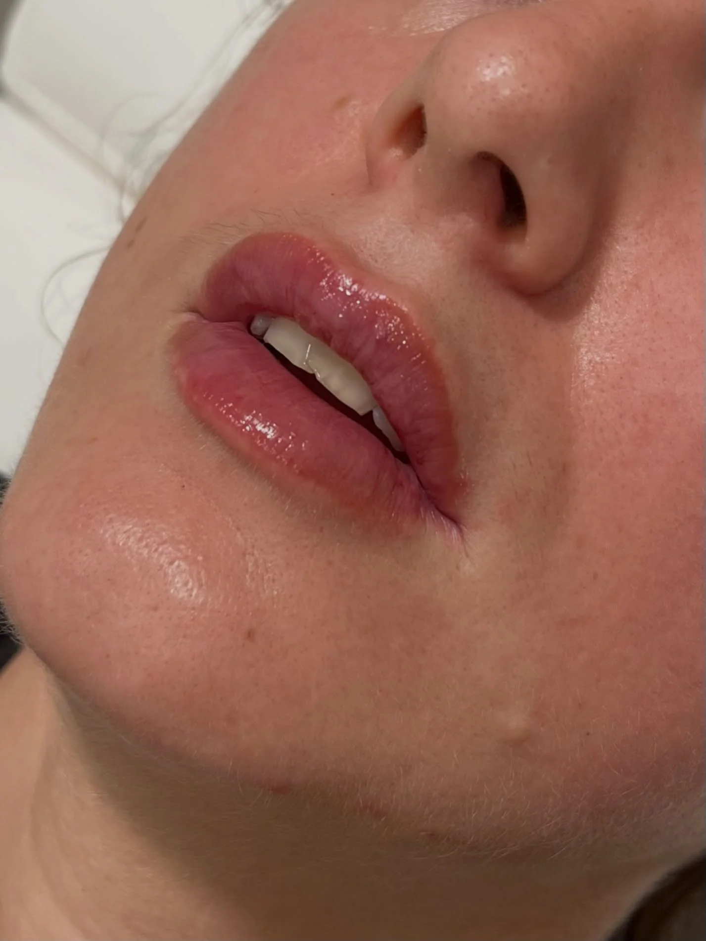Lip filler transformation. 0.7ml RHA Kiss by @teoxane_uk 

DM to book 

#lipfillercheltenham #lipfillerbishopscleeve #lipfillergloucester #aestheticsdoctorcheltenham #naturallipfillercheltenham
