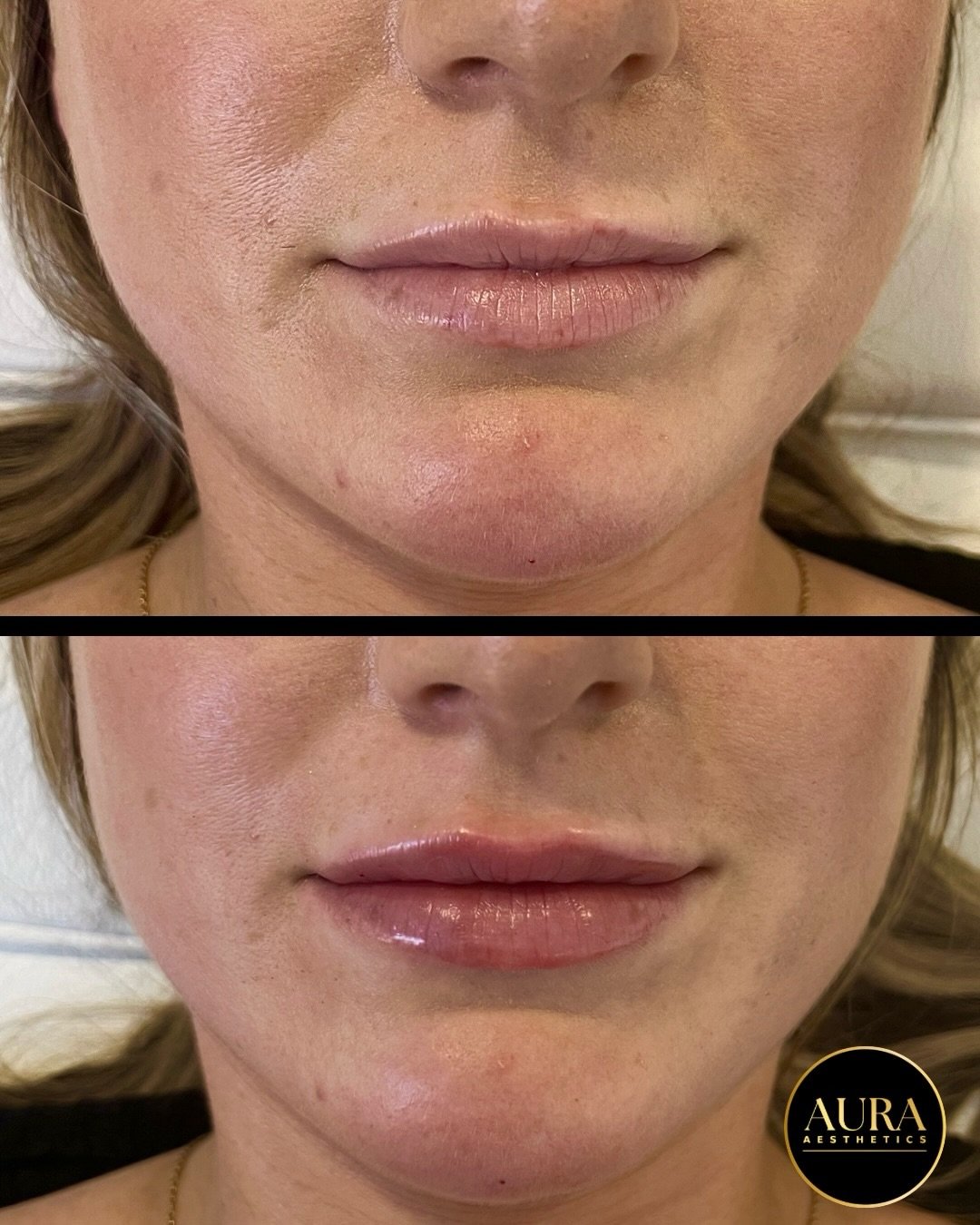 All about the subtle transformations ✨ 

DM to book 

#dermalfillerlips #chinfillercheltenham #naturalfacialtransformation #facialbalancingcheltenham #doctorledaestheticsclinic