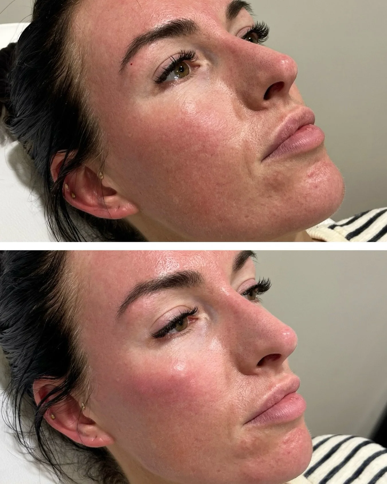 Teoxane babyGLOW&trade; magic. The photos show results before and immediately after treatment 

A refined way of using Teoxane Redensity 1 Skin Booster. ✨
Skin quality focus, hydration boosting and a glow that just keeps getting better. babyGLOW by T