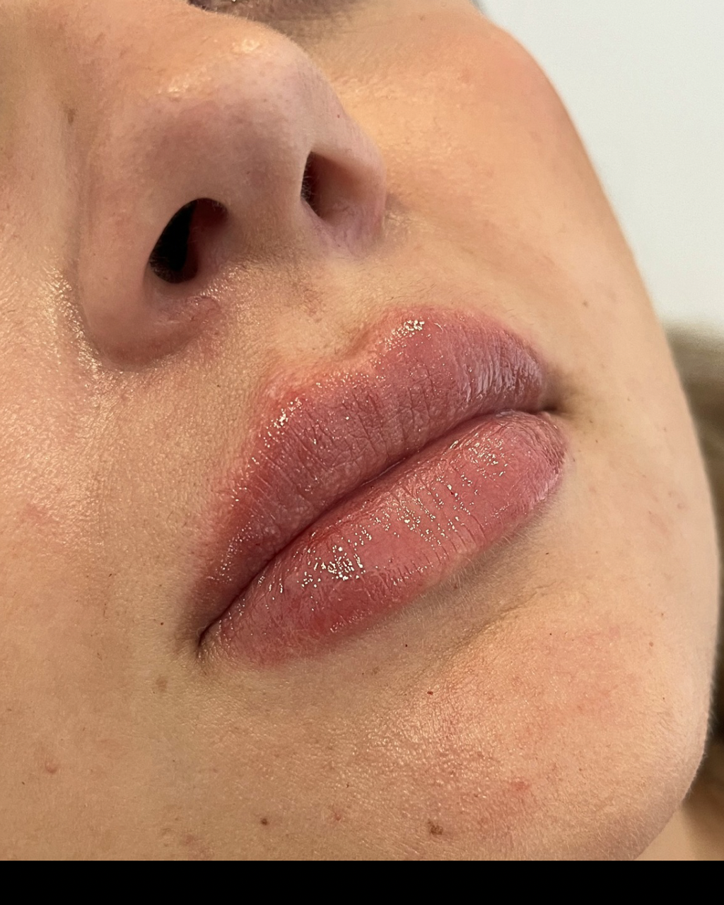 A person who has had lip filler in bishops cleeve done by a doctor