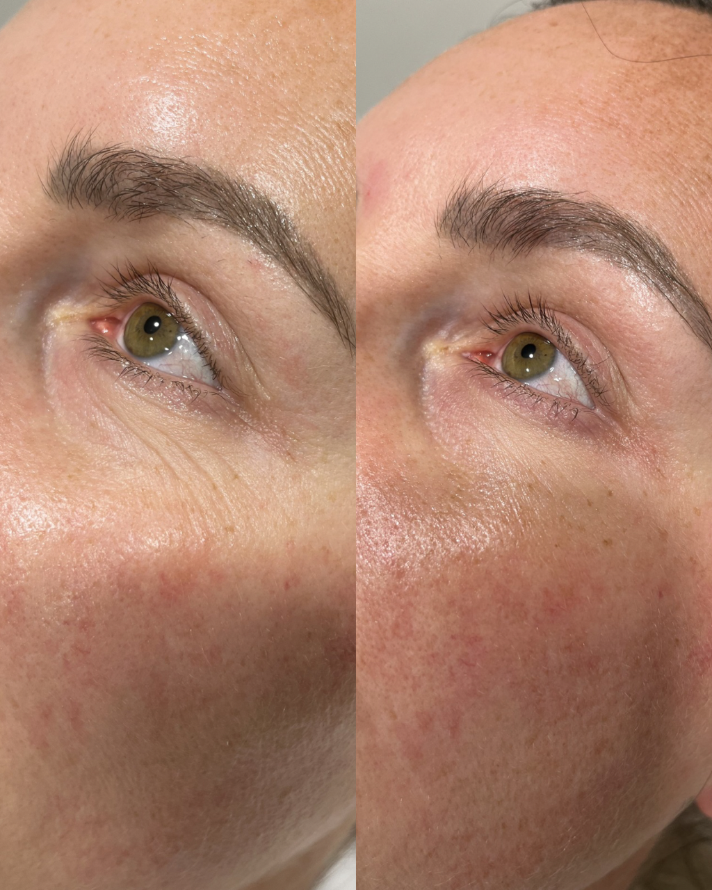 A before and after of polynucleotide injections done for skin tightening and reduction in fine lines and wrinkles in bishops cleeve cheltenham