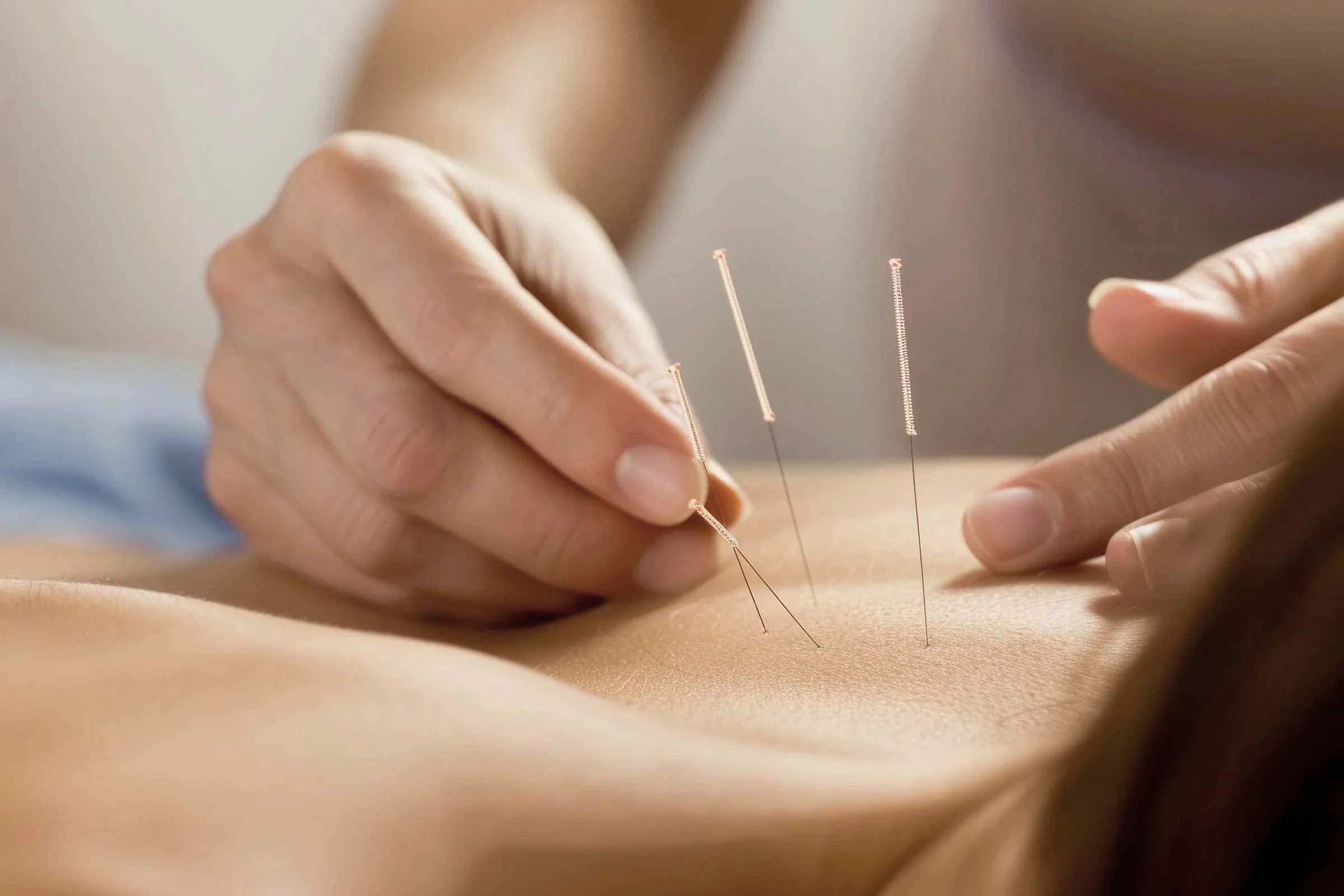 Close-up of hands placing thin acupuncture needles into a person's skin.