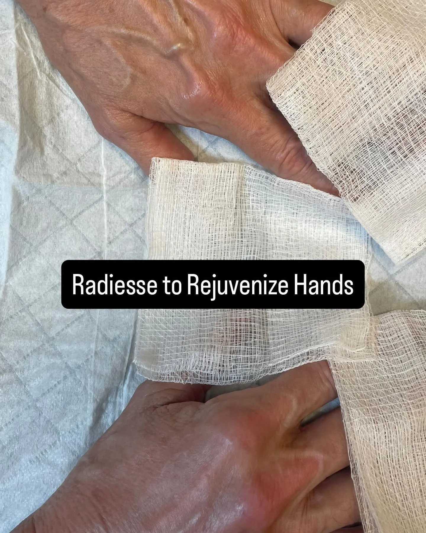 Don&rsquo;t forget your hands! SPF, micro-feeling and collagen stimulation are as important as treating the neck and d&eacute;collet&eacute; #leblanchealth #radiesse #handfiller #handfillersbeforeandafter #nashville #nashvillemedspa #botox