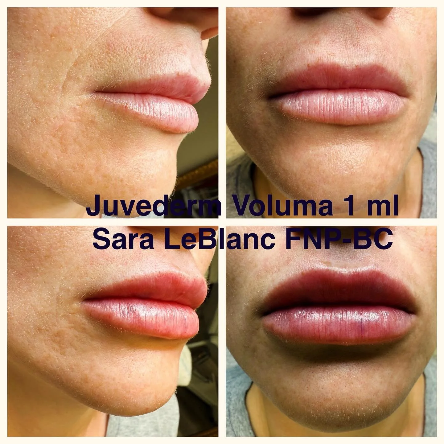 Lips for days 💕#juvederm #leblanchealth #voluma #lipfillers #lipfillerbeforeandafter