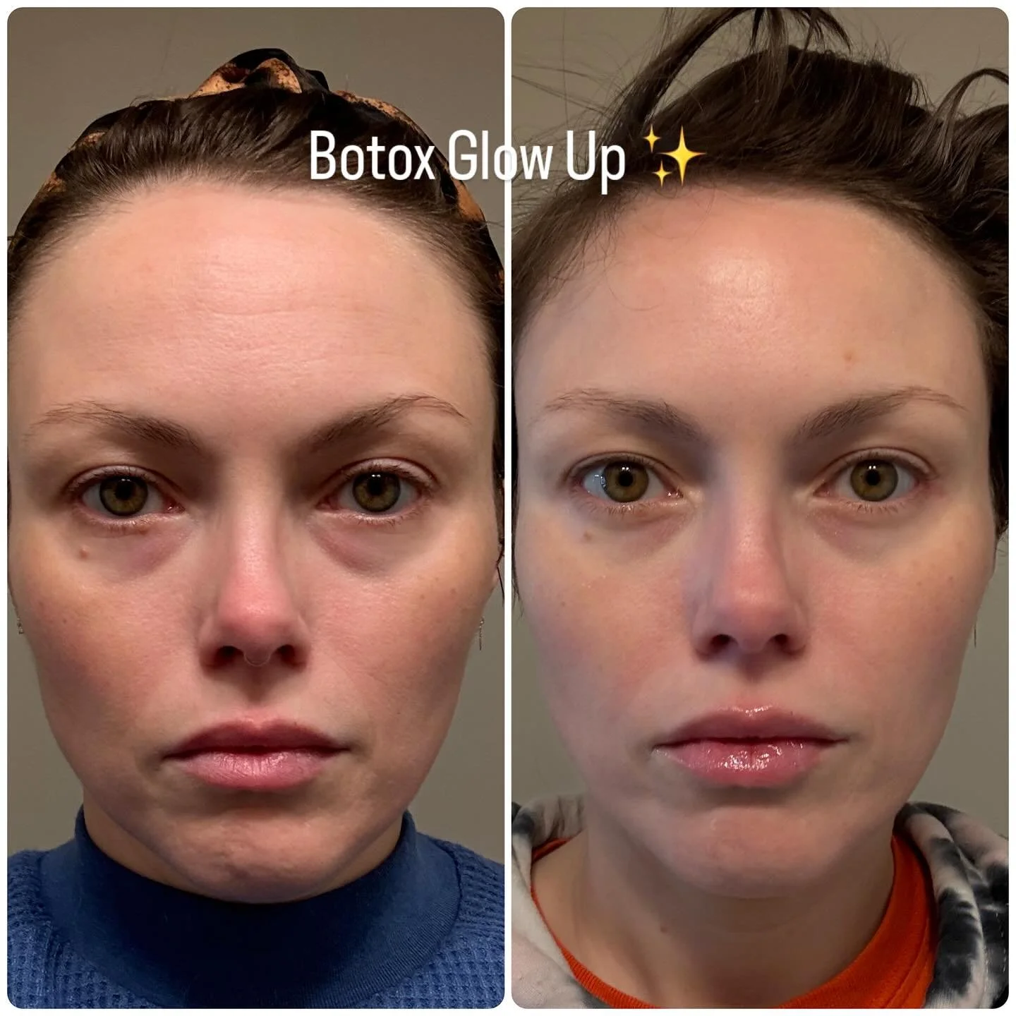 Just a little Tox Boost 💕 #botox #nashvillebotox #nashvillemedspa #leblanchealth