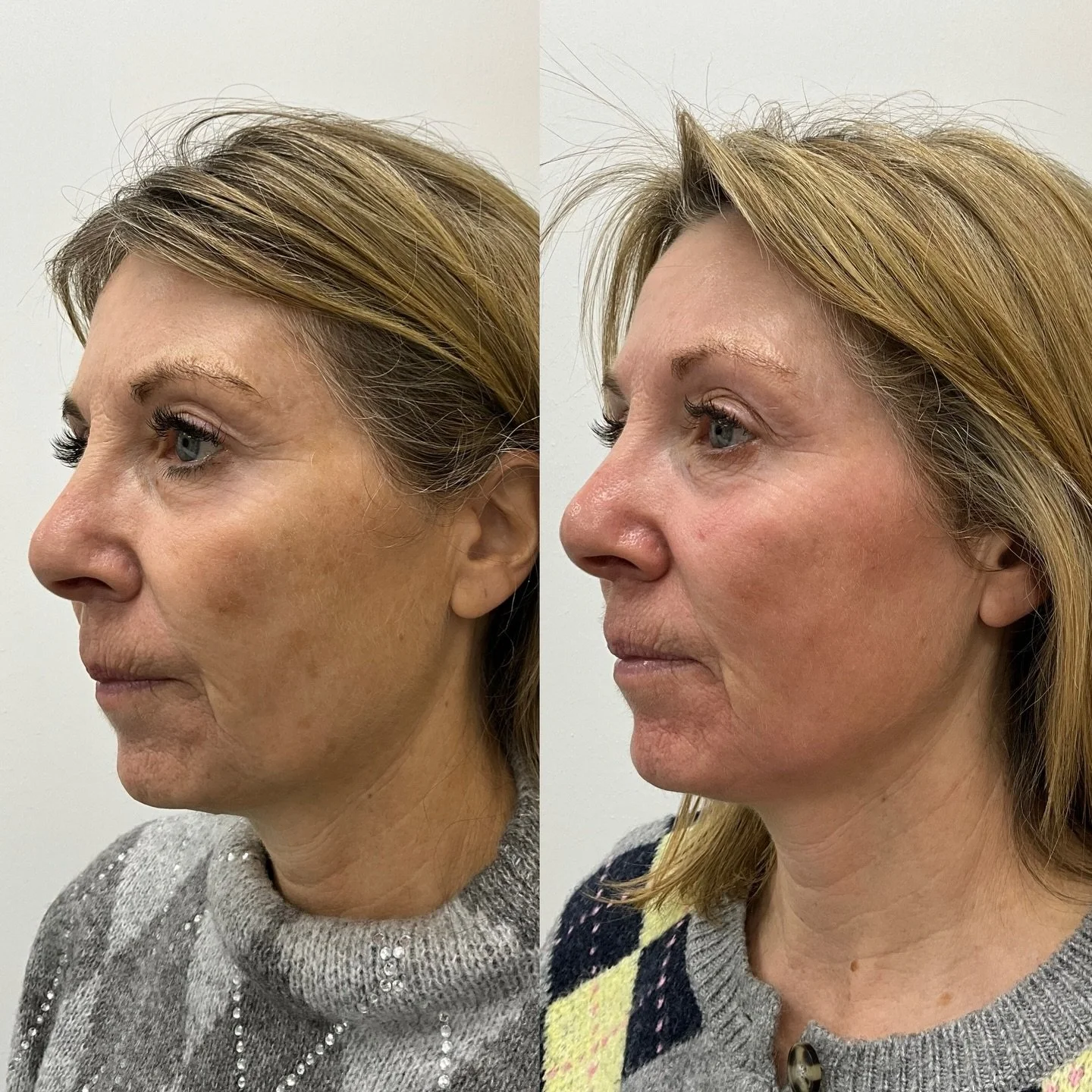 1 Month between photos 

The concern: years of built-up, stubborn pigmentation, visibly reduced in just one month.

All it took was one treatment.

We started with a consultation, where we discussed all available options. Due to time constraints, we 
