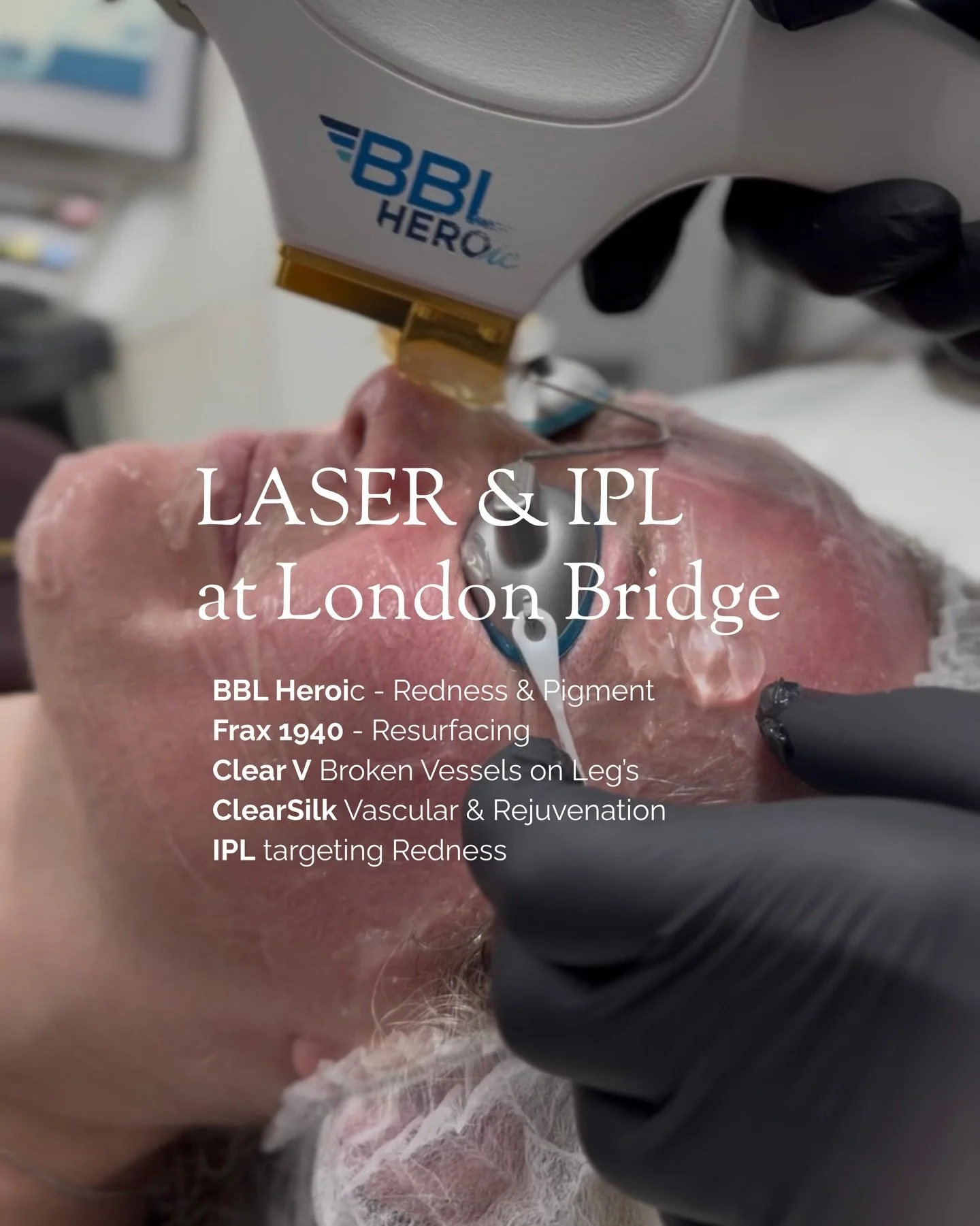 Laser &amp; IPL exclusively available at our London Bridge Partnership with @derma.consult 

The London Bridge clinic specialises in advanced treatments including IPL &amp; Laser&rsquo;s procedures, offering a specialist-led environment where you&rsq