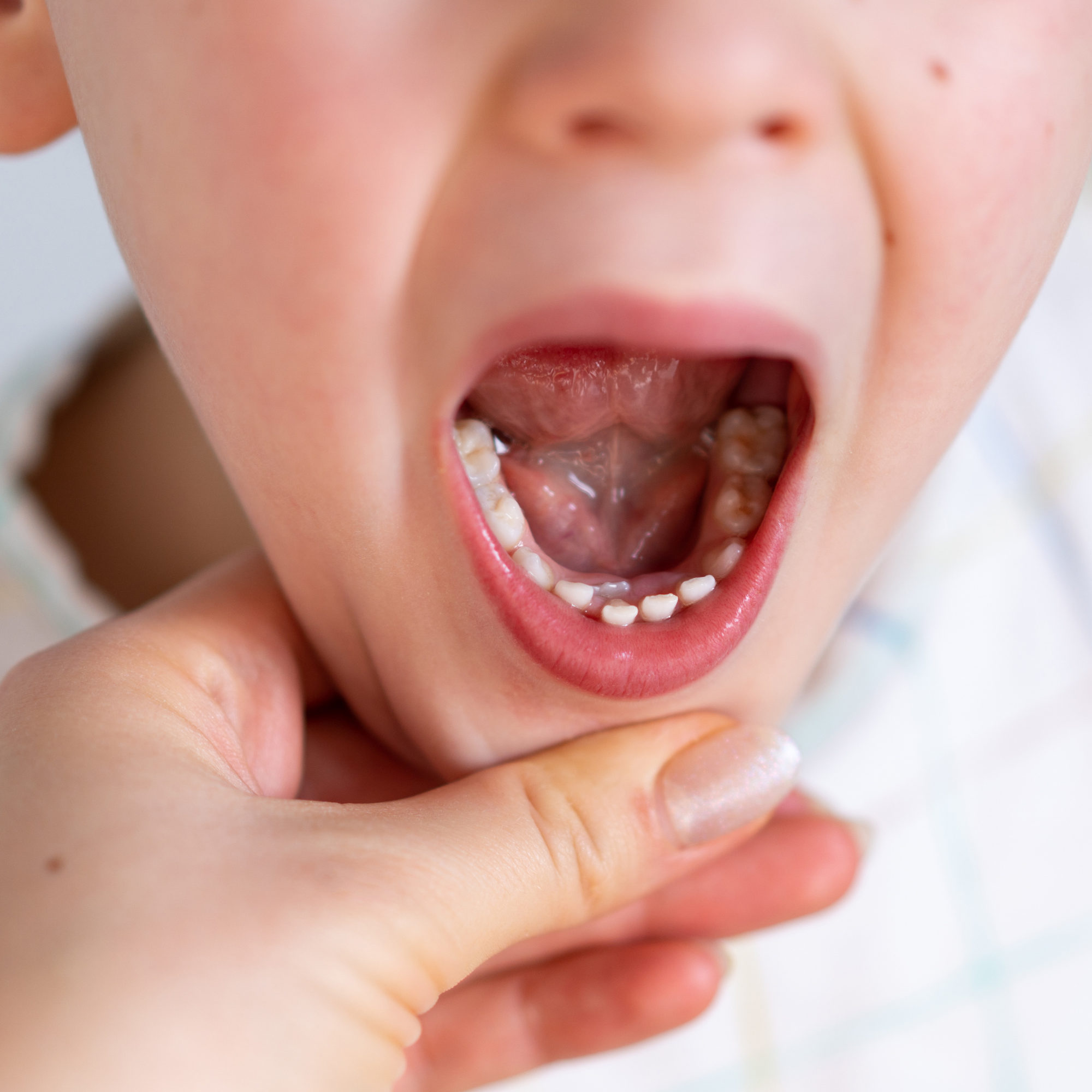 Why Some Kids’ Permanent Teeth Look Crooked at First (And When It’s Normal)