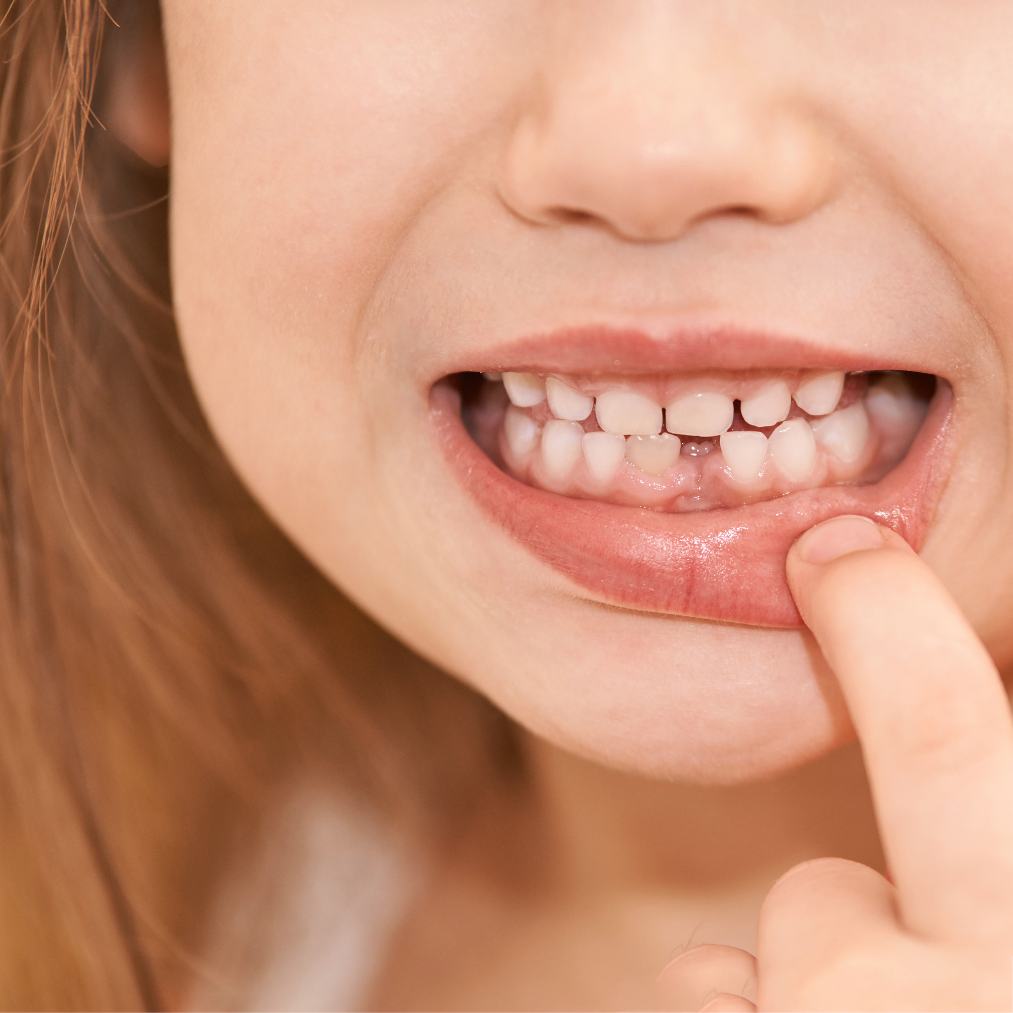 Why Gaps and Crooked Teeth Are Normal in Early Childhood