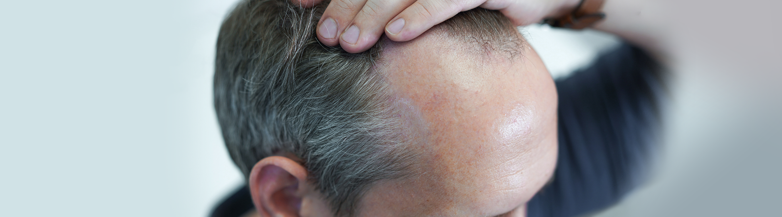 Understanding Hair Loss: Causes, Prevalence, and Innovative Solutions
