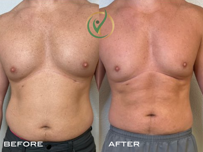 Before and after photo of a man’s torso showing visible fat reduction and increased muscle definition around the chest and abdominal area. The 'before' image shows more body fat, while the 'after' image reveals a toned, firmer physique.