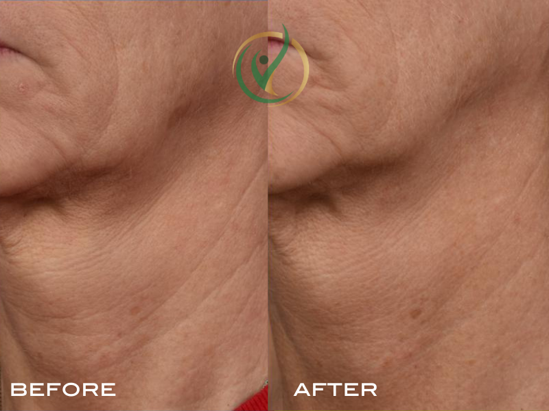Close-up view of the neck area showing skin texture improvement before and after treatment. The left image (before) reveals visible wrinkles and uneven skin tone, while the right image (after) shows smoother skin with reduced wrinkles and improved te