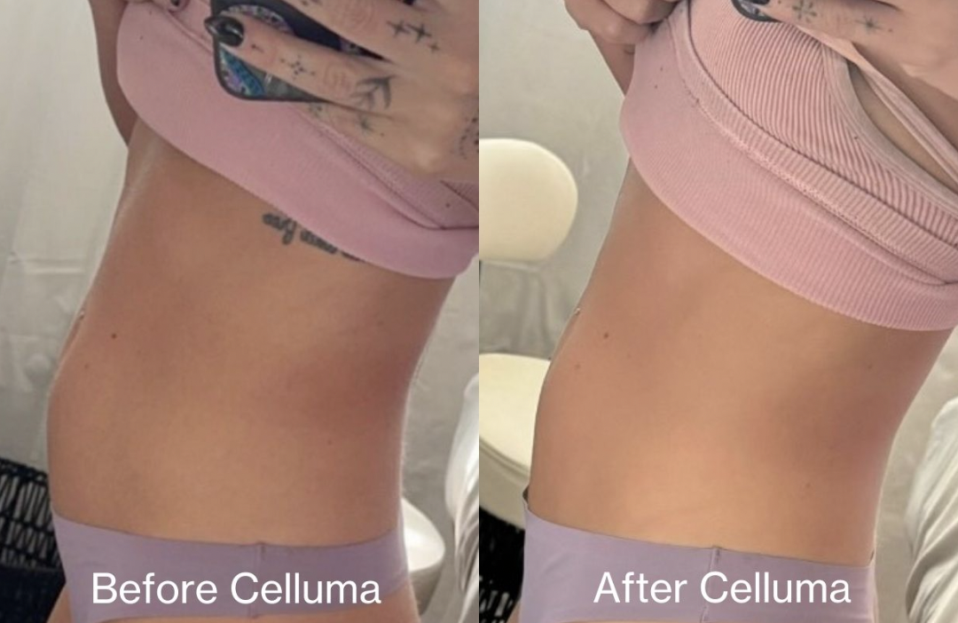 Side-by-side before and after photos showing a woman's midsection from the side. The left image labeled 'Before Celluma' shows a slightly protruding belly, and the right image labeled 'After Celluma' shows a flatter, more toned abdomen after treatmen
