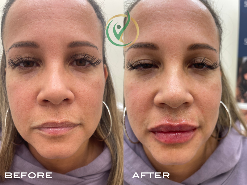 Before and after close-up of a woman's face following a cosmetic lip filler treatment. The 'before' image shows a natural lip shape, while the 'after' image reveals fuller, more defined, and glossier lips. Both images feature the same lighting and ba