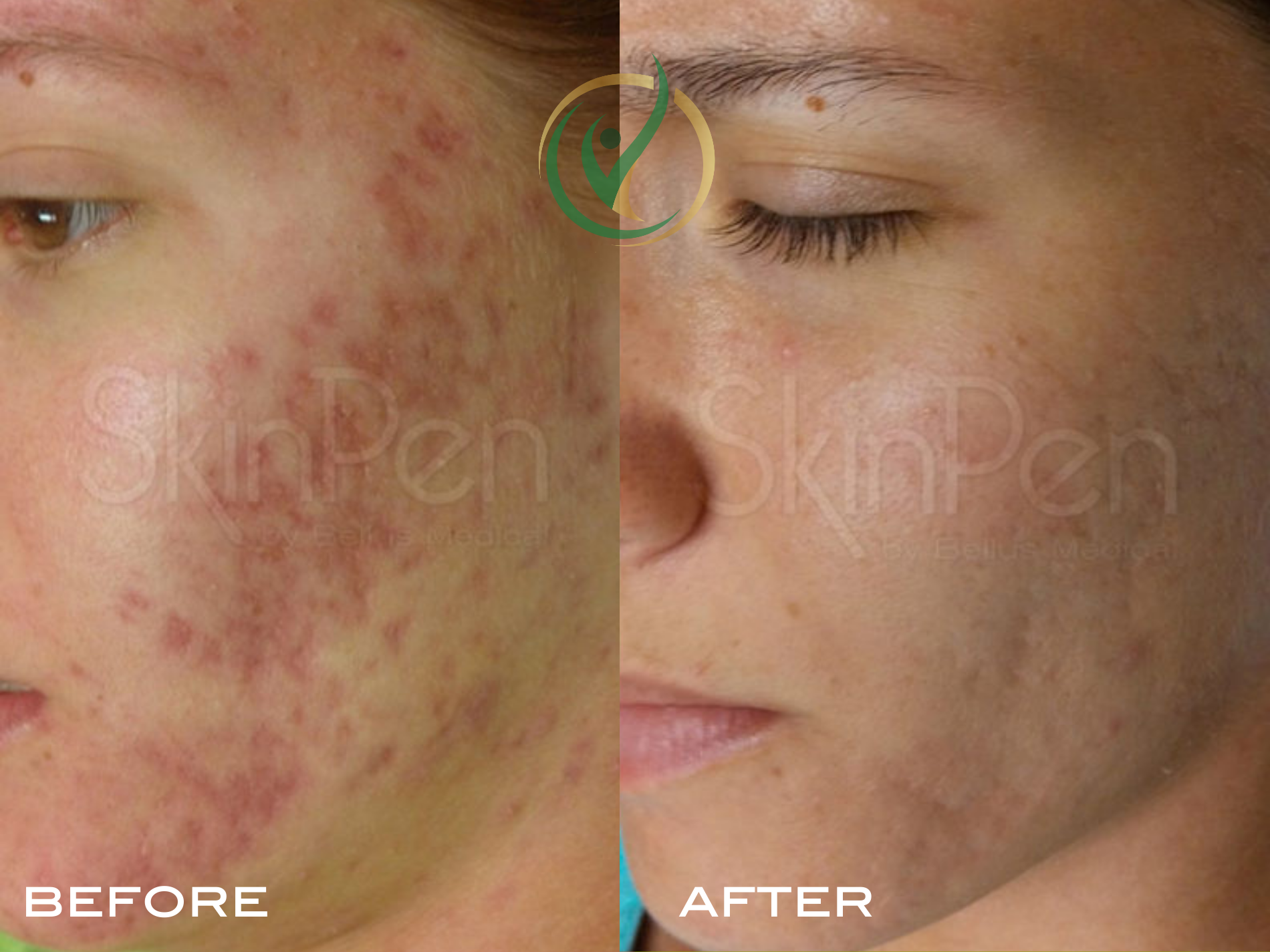 Close-up of cheek showing a marked improvement in acne and redness. The left image (before) displays pronounced acne lesions and inflamed skin. The right image (after) shows clearer skin with reduced acne and less redness.