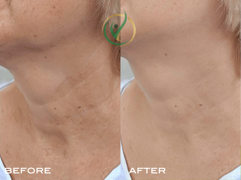 Comparison of neck skin showing improvement from earlier to later stage, labeled 'Before' and 'After'.