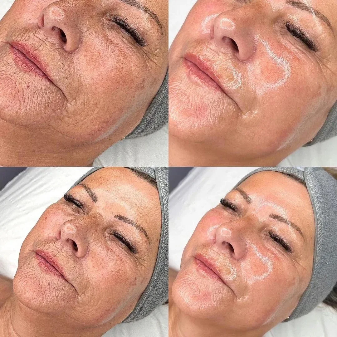 Before and after images showing a woman receiving a skincare treatment that reduces wrinkles and improves skin texture.