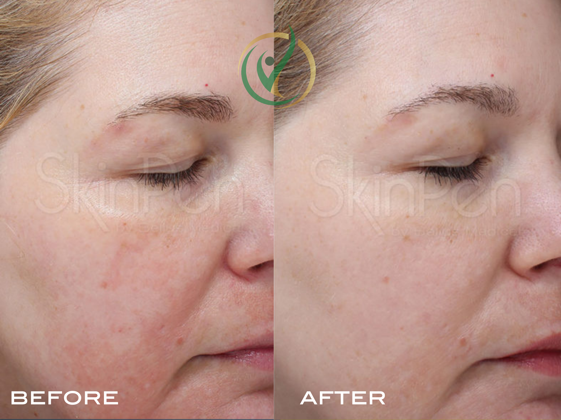 Close-up of a woman’s cheek showing redness and skin texture irregularities before treatment (left) and visibly smoother, clearer skin with reduced redness after treatment (right).