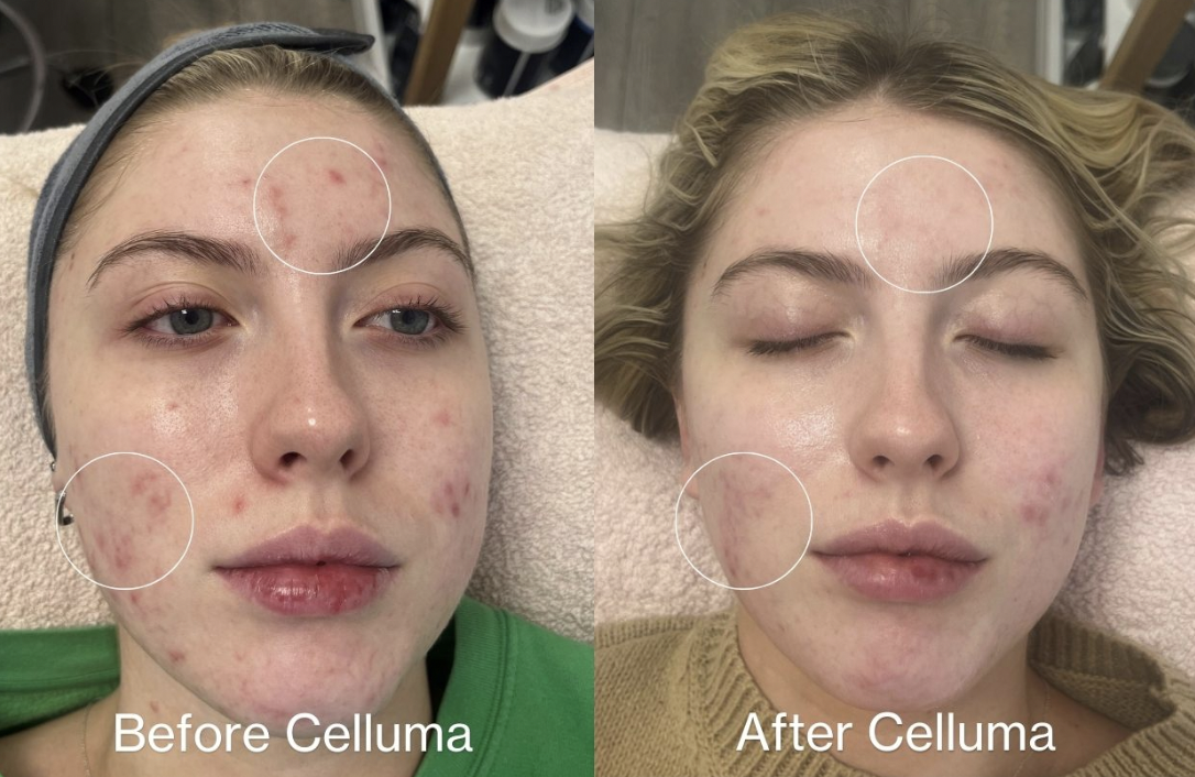 Side-by-side photos of a young woman's face showing acne treatment results with Celluma. The left photo labeled 'Before Celluma' shows red acne spots on the forehead, cheeks, and chin. The right photo labeled 'After Celluma' shows reduced redness and