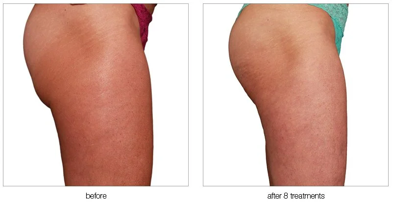 Comparison of skin on woman's thigh before and after 8 treatments, showing improvement in skin texture and appearance.