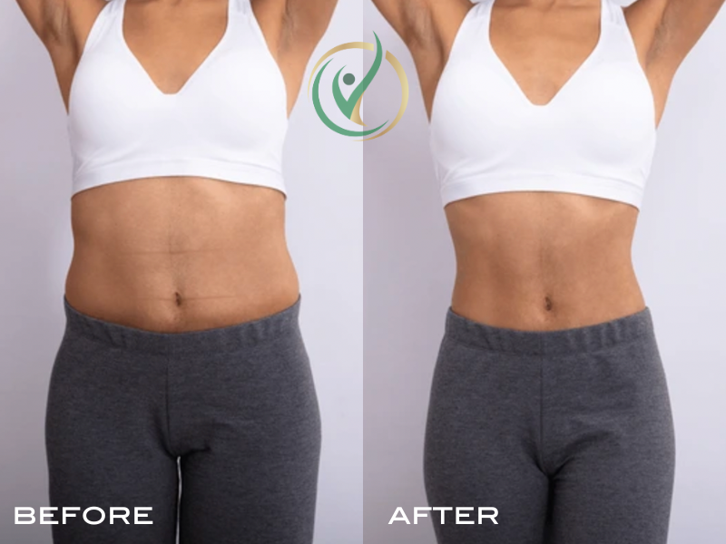 Side-by-side comparison of a woman's torso showing weight loss or body toning, labeled 'Before' and 'After'.