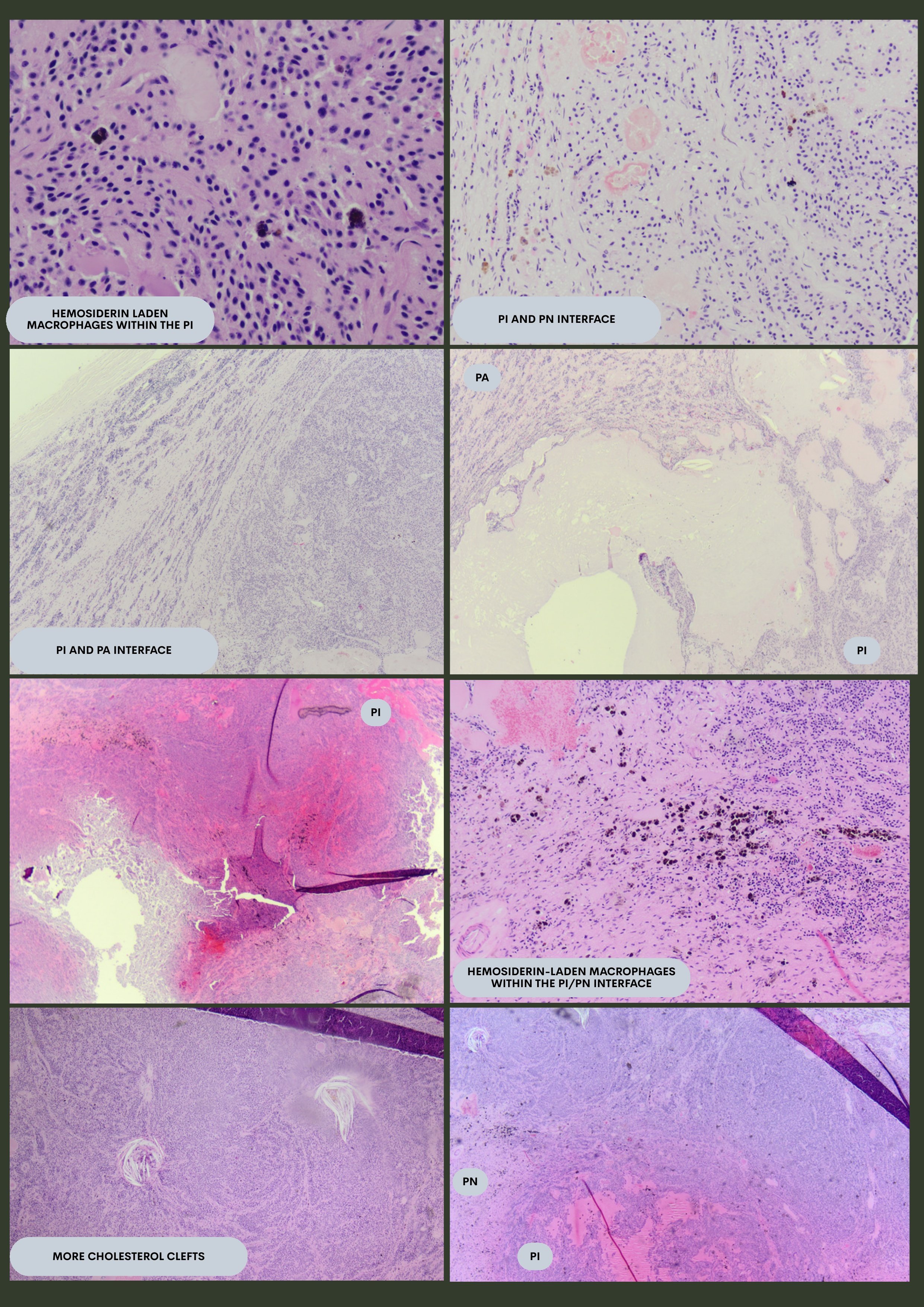 Pituitary Pars Intermedia Dysfunction