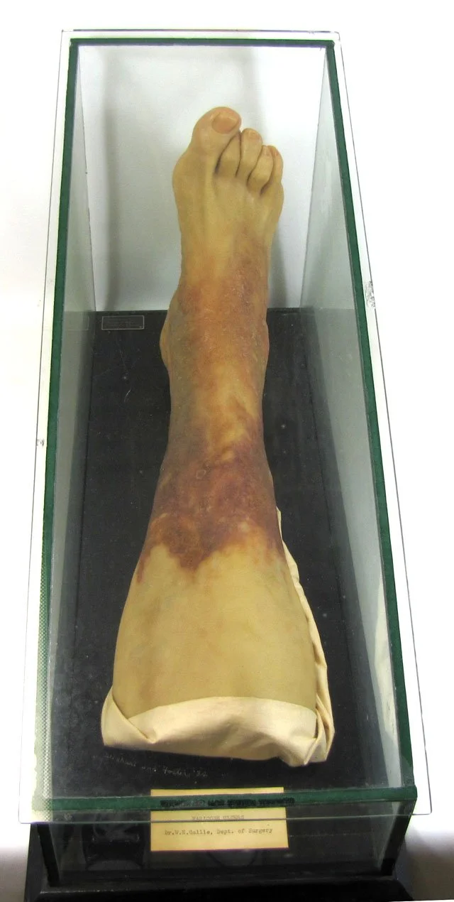 This is not a severed leg but rather a "moulage" or wax model — in this case it depicts a leg with varicose ulcers. Moulages were used prior to the invention of 3D modeling to instruct medical students and professionals about the appearance of uncomm